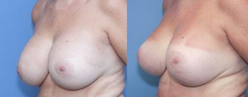 Breast Lift with Augmentation Before & After Gallery - Patient 58179138 - Image 3