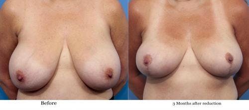 Breast Lift Before & After Gallery - Patient 58179139 - Image 1