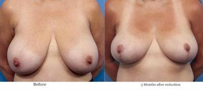 Breast Lift Before & After Gallery - Patient 58179139 - Image 1