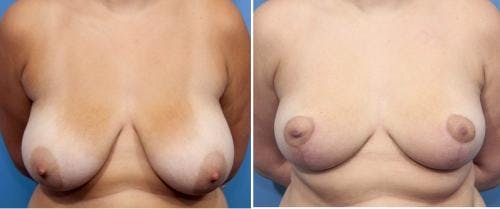 Breast Reduction Before & After Gallery - Patient 58179140 - Image 1
