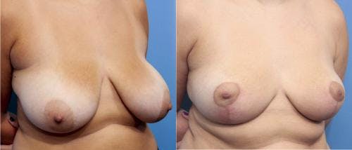 Breast Reduction Before & After Gallery - Patient 58179140 - Image 2