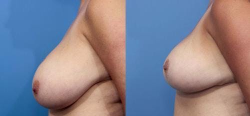 Breast Lift Before & After Gallery - Patient 58179139 - Image 2