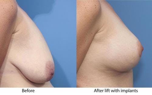 Breast Lift with Augmentation Before & After Gallery - Patient 58179143 - Image 2