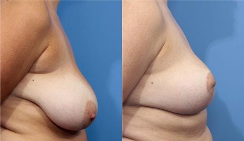Breast Reduction Before & After Gallery - Patient 58179140 - Image 3