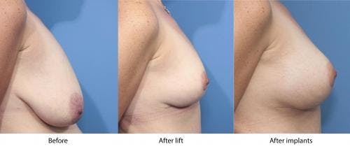 Breast Lift with Augmentation Before & After Gallery - Patient 58179143 - Image 3