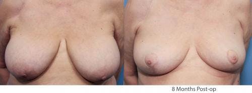 Breast Lift Before & After Gallery - Patient 58179141 - Image 1