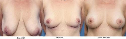 Breast Lift with Augmentation Before & After Gallery - Patient 58179143 - Image 4
