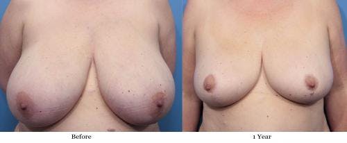 Breast Reduction Before & After Gallery - Patient 58179142 - Image 1
