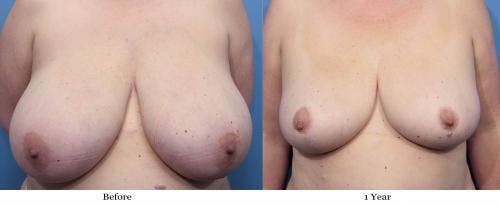 Breast Reduction