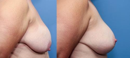 Breast Lift Before & After Gallery - Patient 58179144 - Image 2