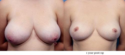 Breast Reduction Before & After Gallery - Patient 58179148 - Image 1