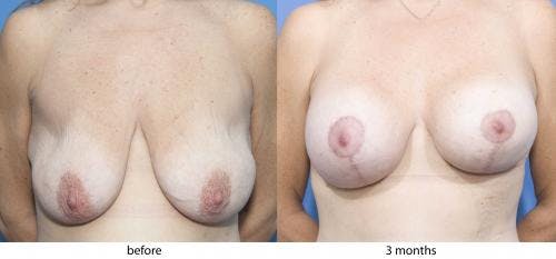 Breast Lift with Augmentation Before & After Gallery - Patient 58179146 - Image 1