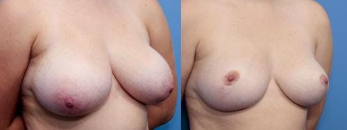 Breast Reduction Before & After Gallery - Patient 58179148 - Image 2