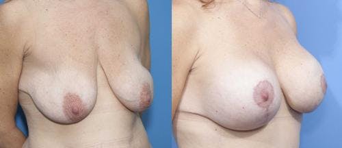Breast Lift with Augmentation Before & After Gallery - Patient 58179146 - Image 2