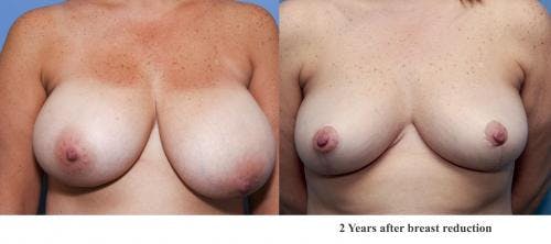 Breast Lift Before & After Gallery - Patient 58179147 - Image 1