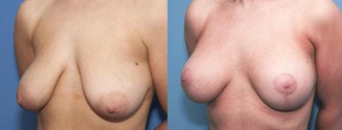 Breast Lift with Augmentation Before & After Gallery - Patient 58179149 - Image 1