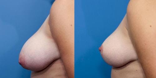 Breast Reduction Before & After Gallery - Patient 58179148 - Image 5