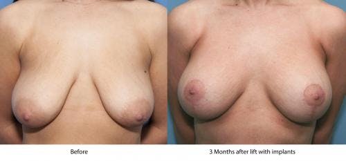 Breast Lift with Augmentation Before & After Gallery - Patient 58179149 - Image 2