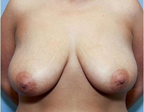 Breast Lift Before & After Gallery - Patient 58179155 - Image 1