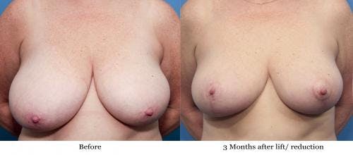 Breast Reduction Before & After Gallery - Patient 58179150 - Image 1
