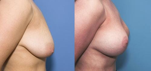Breast Lift with Augmentation Before & After Gallery - Patient 58179149 - Image 3