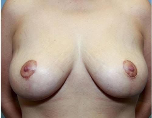 Breast Lift Before & After Gallery - Patient 58179155 - Image 2