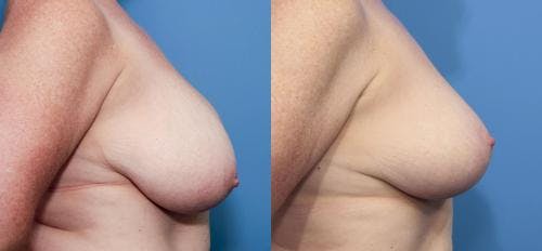 Breast Reduction Before & After Gallery - Patient 58179150 - Image 2