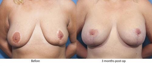Breast Lift with Augmentation Before & After Gallery - Patient 58179153 - Image 1