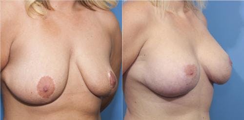 Breast Lift with Augmentation Before & After Gallery - Patient 58179153 - Image 2