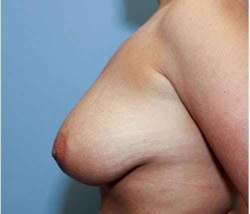 Breast Lift Before & After Gallery - Patient 58179155 - Image 5