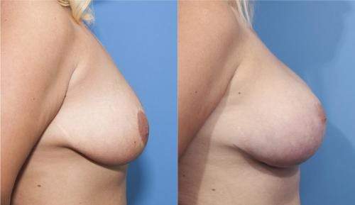 Breast Lift with Augmentation Before & After Gallery - Patient 58179153 - Image 3