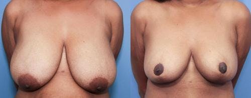 Breast Reduction Before & After Gallery - Patient 58179156 - Image 1
