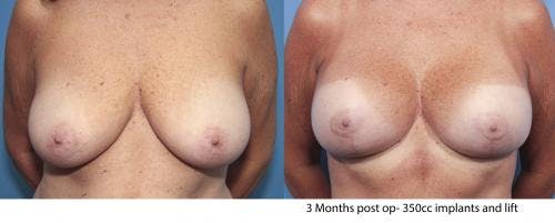 Breast Lift with Augmentation Before & After Gallery - Patient 58179158 - Image 1