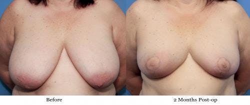 Breast Reduction Before & After Gallery - Patient 58179157 - Image 1