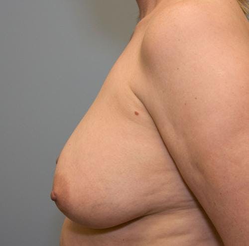 Breast Lift Before & After Gallery - Patient 58179159 - Image 3
