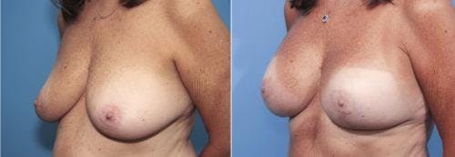 Breast Lift with Augmentation Before & After Gallery - Patient 58179158 - Image 2