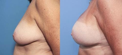 Breast Lift with Augmentation Before & After Gallery - Patient 58179158 - Image 3
