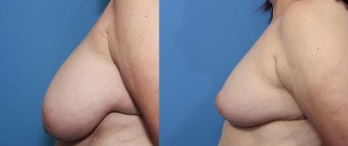 Breast Reduction Before & After Gallery - Patient 58179157 - Image 2