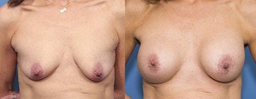 Breast Lift with Augmentation Before & After Gallery - Patient 58179161 - Image 1