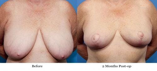 Breast Reduction Before & After Gallery - Patient 58179160 - Image 1