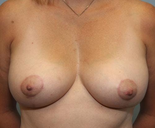 Breast Lift Before & After Gallery - Patient 58179159 - Image 2