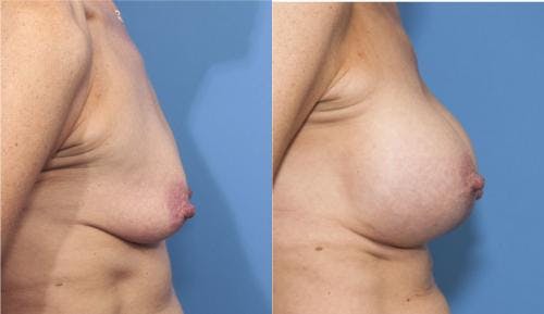Breast Lift with Augmentation Before & After Gallery - Patient 58179161 - Image 2