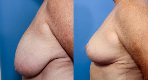Breast Reduction Before & After Gallery - Patient 58179160 - Image 2