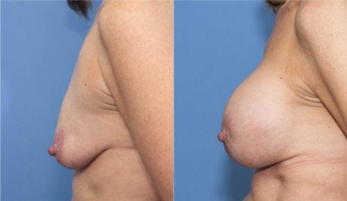 Breast Lift with Augmentation Before & After Gallery - Patient 58179161 - Image 3
