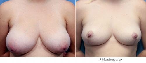 Breast Reduction Before & After Gallery - Patient 58179162 - Image 1