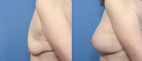 Breast Lift with Augmentation Before & After Gallery - Patient 58179163 - Image 2