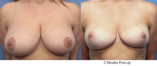 Breast Reduction Before & After Gallery - Patient 58179164 - Image 1