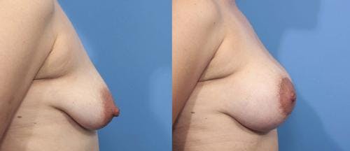 Breast Lift with Augmentation Before & After Gallery - Patient 58179166 - Image 2