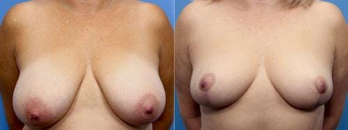 Breast Reduction Before & After Gallery - Patient 58179167 - Image 1