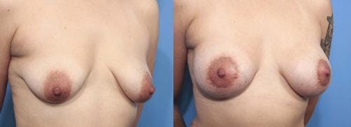 Breast Lift with Augmentation Before & After Gallery - Patient 58179166 - Image 3